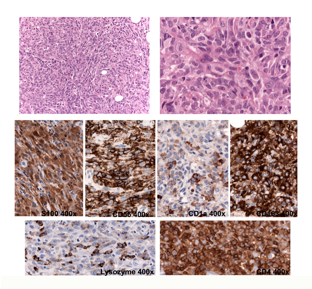 Morphology of the indeterminate dendritic tumor